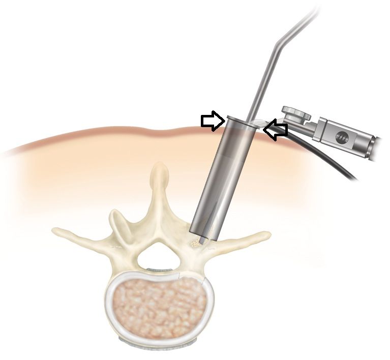 Percutaneous surgery. See how small the skin opening and the overall surgical injury are