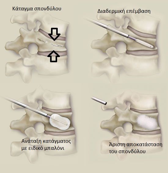 Kyphoplasty surgery to repair a vertebral fracture