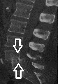 Patient with spondylolisthesis between 4th and 5th lumbar vertebrae