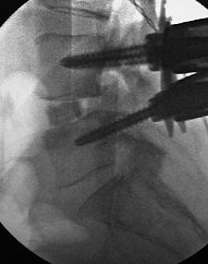 Rehabilitation with percutaneous spinal fusion and implant in the disc. The spondylolisthesis has been redone.